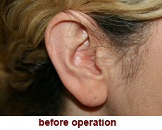 plastic-surgery-prominent-ear 